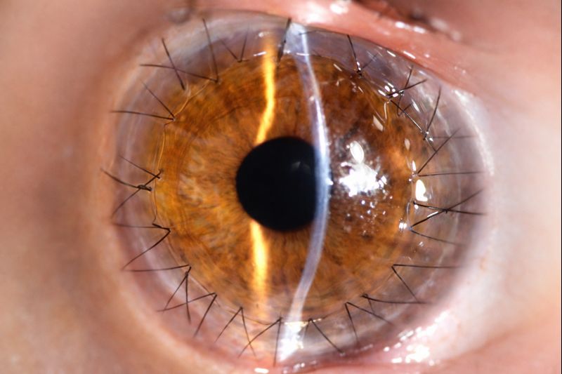 Transplantes de cornea