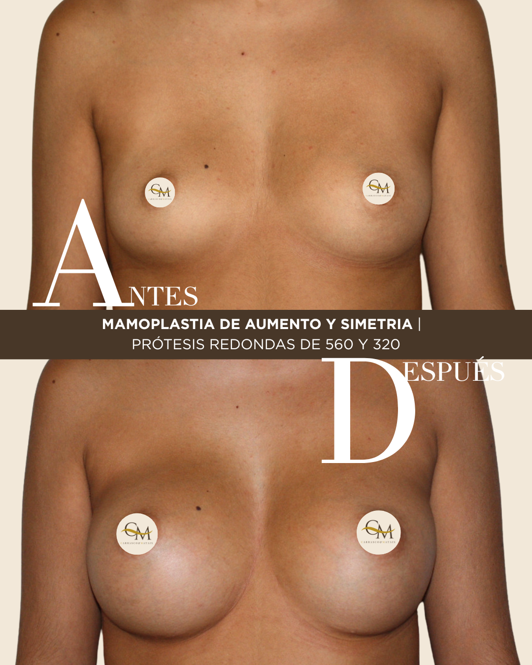 Aumento antes y después con implantes de 320cc ( quitar tatus y colgante) (2)