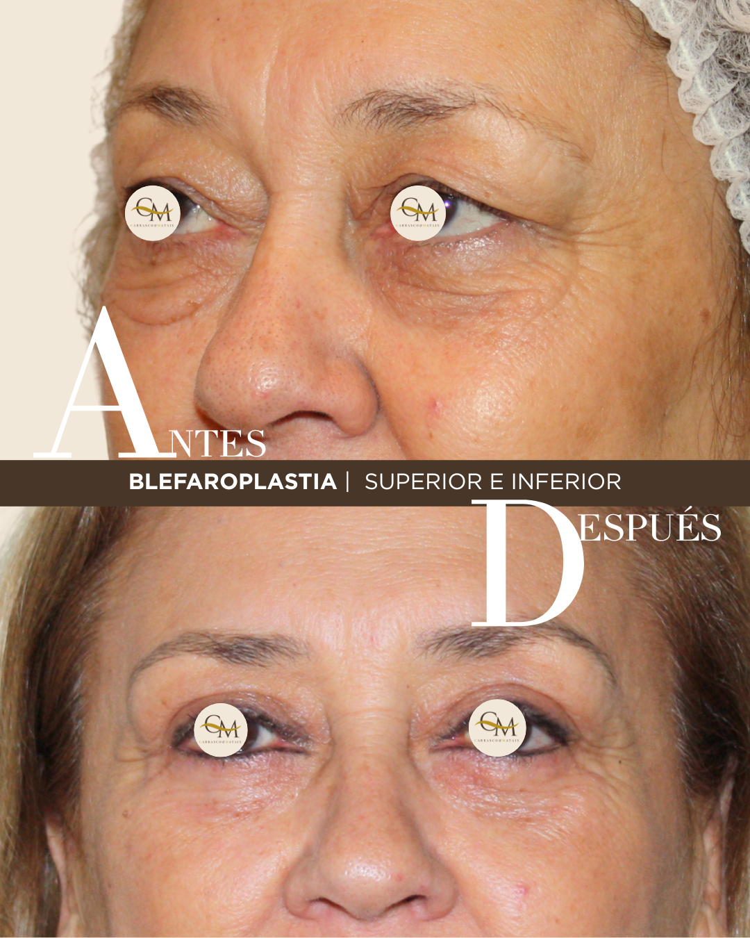 BLEFAROPLASTIA (2)