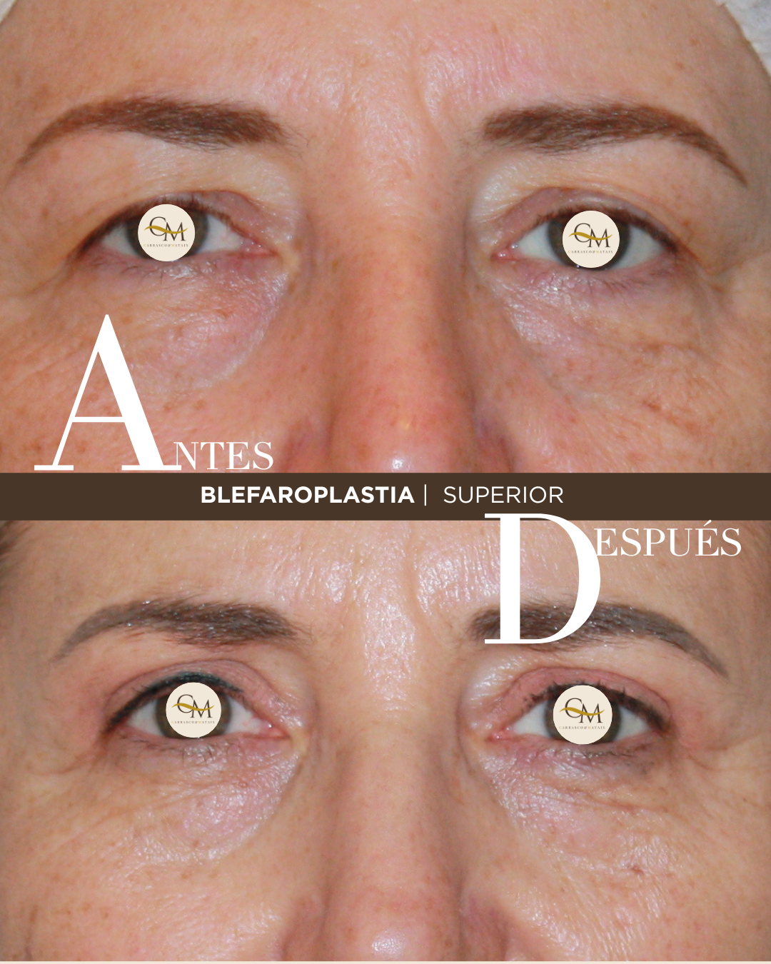 BLEFAROPLASTIA (4)