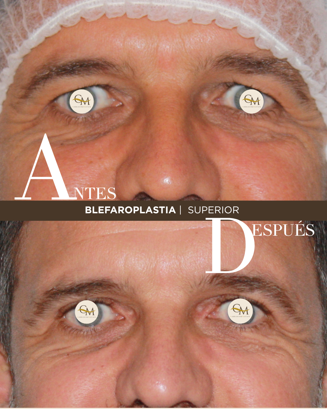 BLEFAROPLASTIA (6)