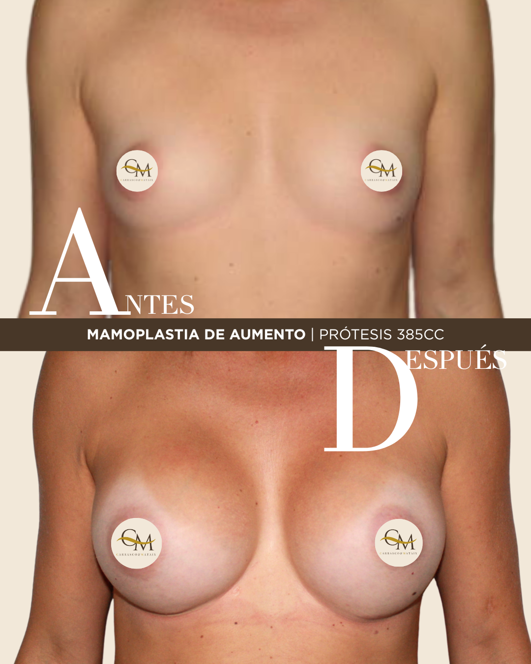 MAMOPLASTIA DE AUMENTO (2)