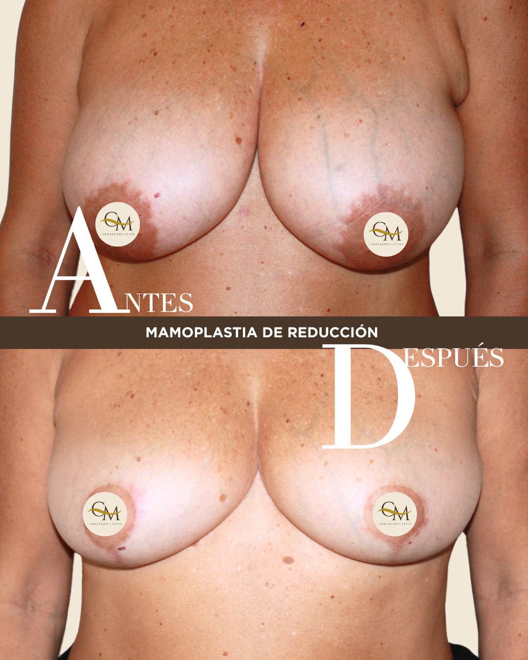 REDUCCION ANTES Y DESPUES ( DCHA 343 E IZQDA 365)