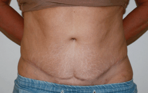¿Qué es una abdominoplastia? Guía médica para una cirugía segura en Sevilla