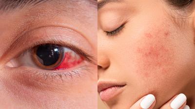 luz-pulsada-intensa-facial-ojo-seco