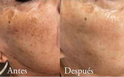 antes-y-despues-laser-co2