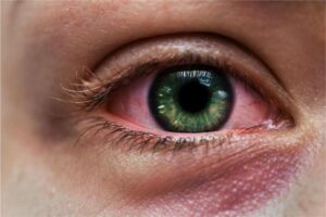 ¿Por qué se ponen los ojos rojos en la piscina? Causas y cómo aliviar la irritación